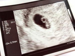 双子を妊娠！【エコー検査】で分かることを解説！いつ分かる？